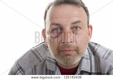 Man with Black Eye Shiner. Man's face after the fight and assault. Middle-aged Caucasian male Emotional Portrait with a Real Bruise after the fight. Bully and Teaser. HiddenViolence