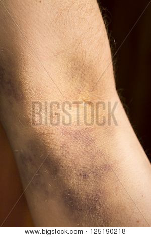 large hematoma on human arm after blood test black background