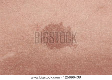 Close-up of brown birthmark on skin texture