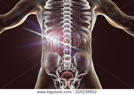 Treatment of kidney cancer with laser, conceptual image. 3D illustration. Concept of laserotherapy of tumors