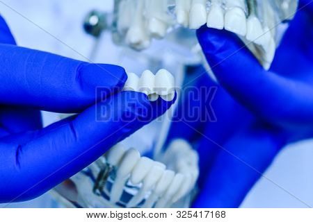 Doctor Hands Holding Teeth Model In Dental Clinic. Teeth Model Held By Real Dentist With Blue Gloves