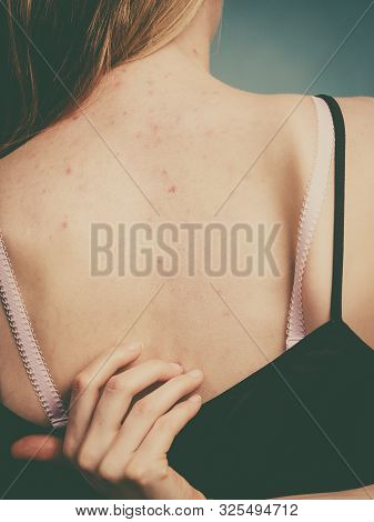 Woman With Skin Problem Acne On Back