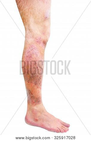 Atopic dermatitis (AD), also known as atopic eczema, is a type of skin inflammation (dermatitis) .