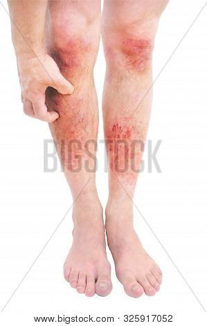 Atopic Dermatitis (ad), Also Known As Atopic Eczema, Is A Type Of Skin Inflammation (dermatitis).ecz