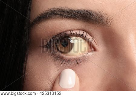 Woman Checking Her Health Condition, Closeup. Yellow Eyes As Symptom Of Problems With Liver