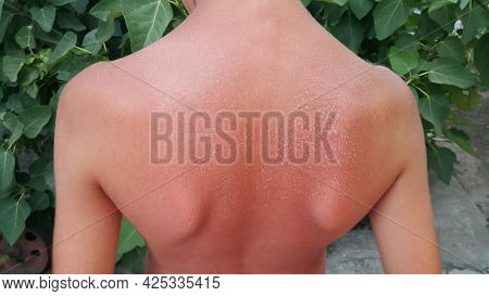 Blisters On The Back From Sunburn. A Young Guy On Vacation At The Beach Caught Fire From The Rays Of