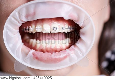 Close Up Of Patient With Cheek Retractor In Mouth Demonstrating Dental Braces On White Teeth. Woman 
