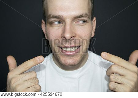 Mans Smile With Braces On The Teeth Of The Upper Jaw