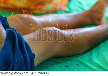 Close-up Of Khee And Leg With Steel Needle During Procedure Of Acupuncture Therapy. Alternative Medi