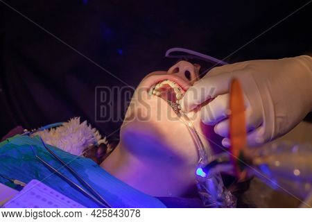 Bonding Of Dental Braces And Expander. Orthodontic Treatment. Dentist Put On Metal Brackets Using Ad