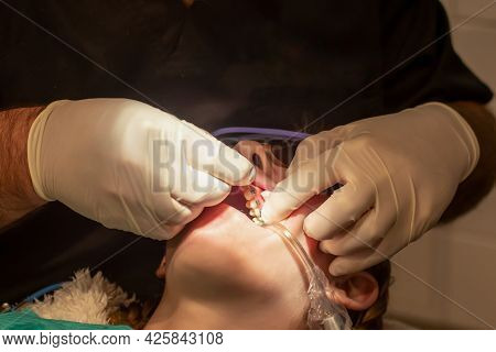 Bonding Of Dental Braces And Expander. Orthodontic Treatment. Dentist Put On Arch Wire On Metal Brac