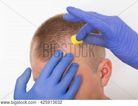 Healing Oil For Scalp Hair Restoration. Hair Follicle Restoration, Close-up. Dihydrotestosterone