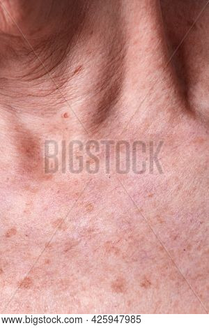 Aging female skin with melasma spots
