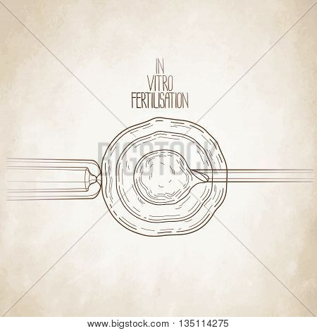 In vitor fertilisation. Artificial insemination. Graphic medical illustration. Vector design isolated aged paper