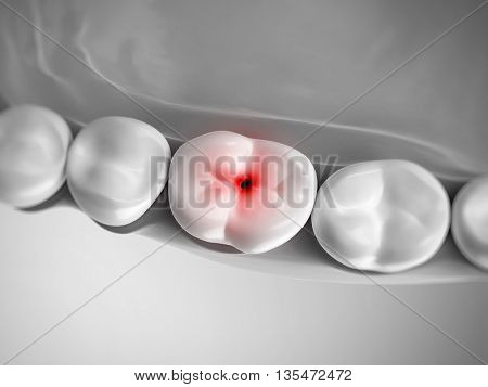 3d rendered, medically accurate 3d illustration of a painful tooth