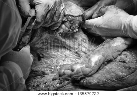 Human's flesh close-up with a fat and other tissues while surgeons lifts up the skin