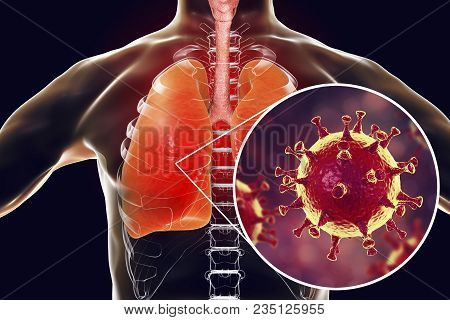 Mers Virus, Meadle-east Respiratory Syndrome Coronavirus In Human Lungs, 3d Illustration