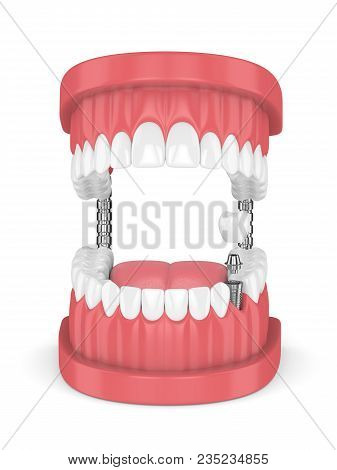 3D Render Of Jaw With Teeth And Dental Premolar Implant