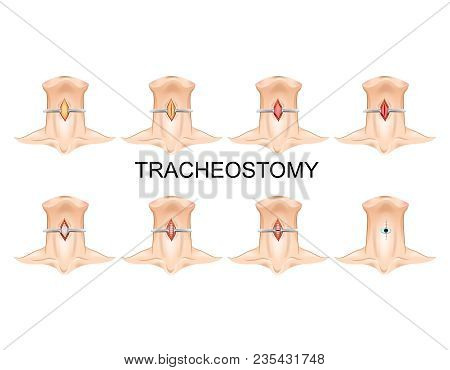 Vector Illustration Of Tracheostomy Tube. Surgical Process