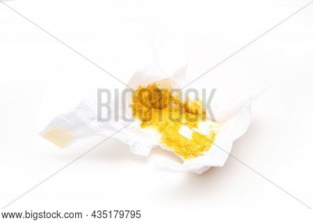 The Dirty Baby Diaper Full Of Sparse Excrement, Because The Child Has A Diarrhoea. Isolated In A Whi