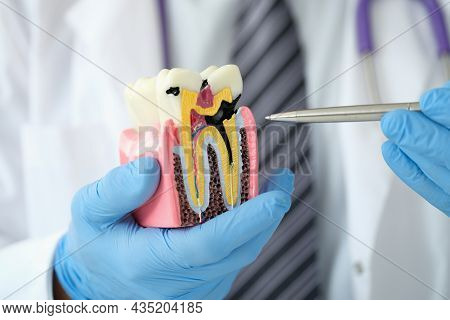 Doctor Dentist Showing Pen On Carious Cavity On Artificial Plastic Model Of Tooth Closeup