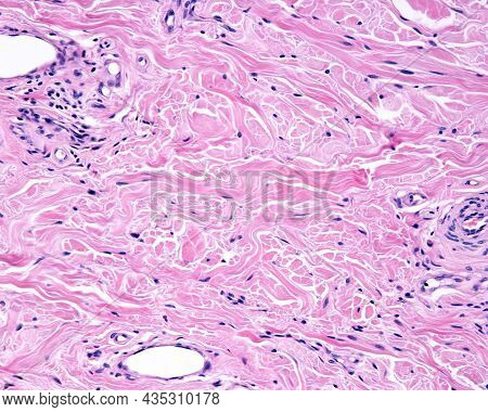 The Reticular Dermis Is A Dense Irregular Connective Tissue With Densely Packed Collagen Fibers, Org