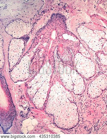 Sebaceous Gland Formed By Multiple Acinar Glands Branch Off A Central Duct. In The Top And Bottom Bo