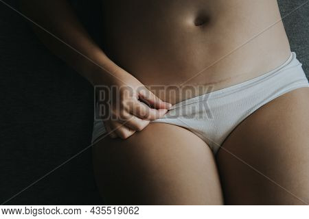 Young Woman In White Panties, Caesarean Section Scar.