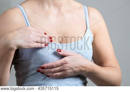 A Woman Is Holding Her Breast, Compaction Of The Soft Tissues Of The Breast. Breast Cancer In Women.
