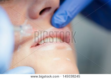Upper Lip Hyaluronan Injection