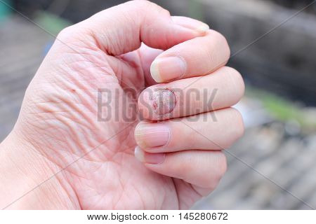 Fungus Infection On Nails Hand, Finger With Onychomycosis. - Soft Focus