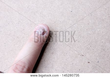 Fungus Infection On Nails Hand, Finger With Onychomycosis. - Soft Focus