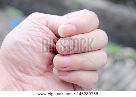 Fungus Infection On Nails Hand, Finger With Onychomycosis. - Soft Focus