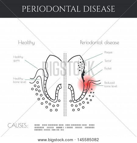 Periodontal disease. Dental infographic.. All objects are conveniently grouped and are easily editable.