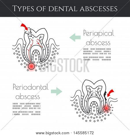 Types of dental abscessesDental infographic.. All objects are conveniently grouped and are easily editable.