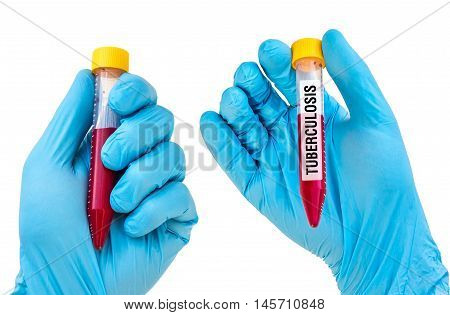 Test-tube With Blood Sample For Tuberculosis