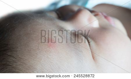 Baby Have Mosquito Bite On Skin And Have Mark