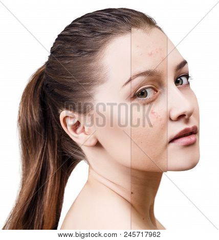 Layer With Bad Skin Unstick From Good Healthy Skin. Isolated On White.