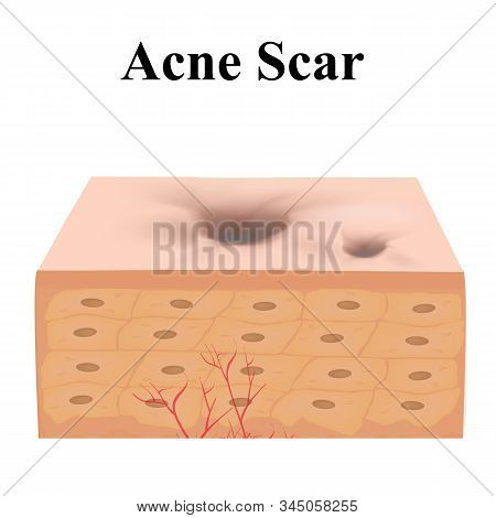 Atrophic Scars. Acne Scar. The Anatomical Structure Of The Skin With Acne. Illustration On Isolated 