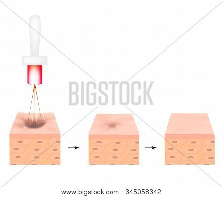 Acne Scars. Laser Scar Atrophic Treatment. The Anatomical Structure Of The Skin With Acne. Illustrat