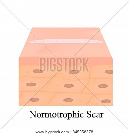 Scars Normotrophic. The Anatomical Structure Of The Skin Scar. Illustration On Isolated Background.