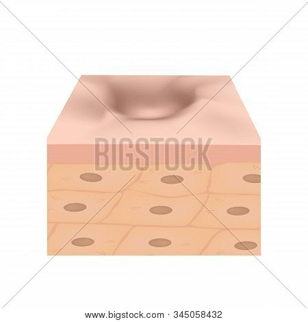 Atrophic Scars. Acne Scar. The Anatomical Structure Of The Skin With Acne. Illustration On Isolated 