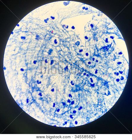 Mycobacterium Tuberculosis In Sputum  Positive 3+.