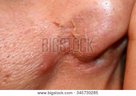 Inflamed Skin On The Face. Acne. Pimples On The Skin. Scars And Peeling.