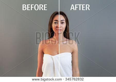 The Concept Of Sunburn. A Young Woman In A Bath Towel Poses On A Gray Background. Skin With And With