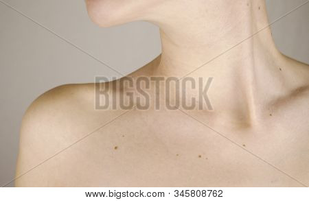 Chin Neck And Clavicle Of A Girl With Lots Of Moles On The Skin Close-up