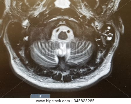 Cerebellum On Brain Ct With Bird-like Appearance