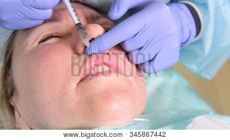 The Cosmetologist Performs A Procedure To Increase The Lips Of A Woman In A Beauty Salon. Skin Care.