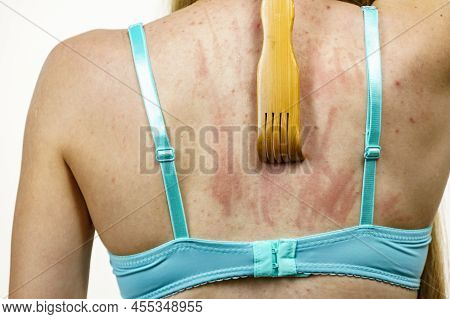 Itchy Skin, Dermatitis, Food Allergies. Woman Using Scratching Wood Stick To Scratch Her Back Side. 