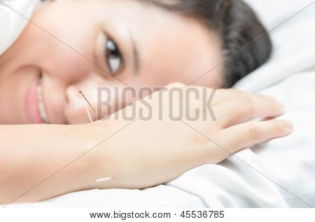 Acupuncture patient with needles along arm